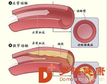 定期检查眼底可及时发现高血脂等疾病