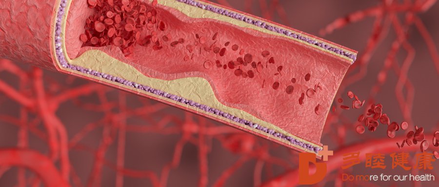 日本血液净化-动脉粥样硬化是怎么形成的呢？